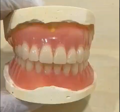 Acrylic Denture