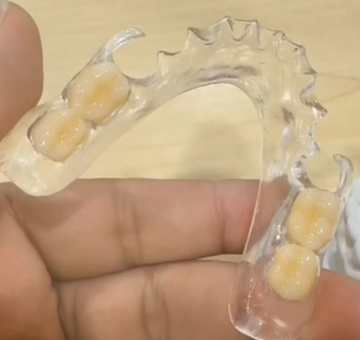 Clear Framework Denture-thumb