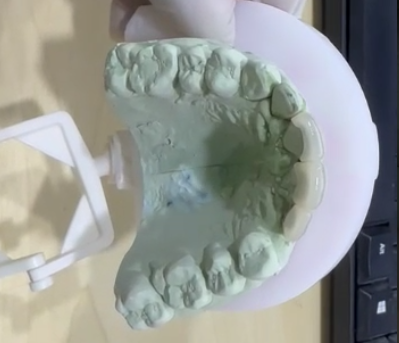 E-Max-Crowns