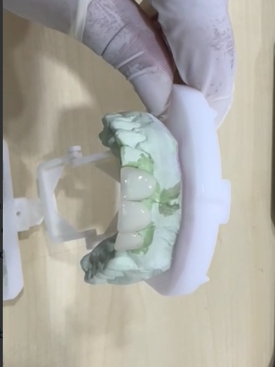 E Max Crowns