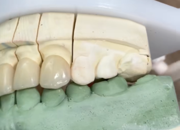 E- max crowns
