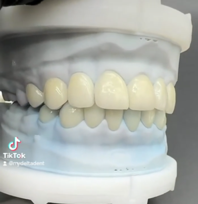Emax Veneers