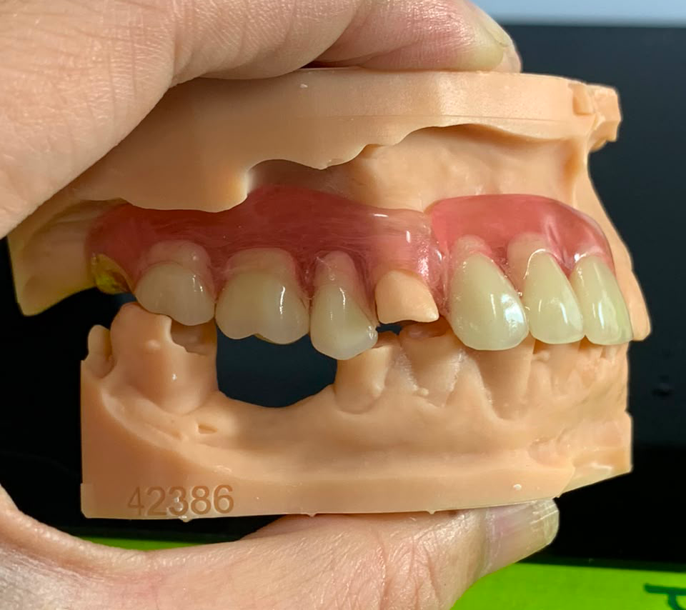 Flexible Denture