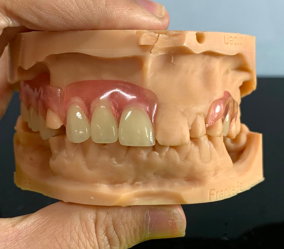 Flexible-Acrylic-Dentures