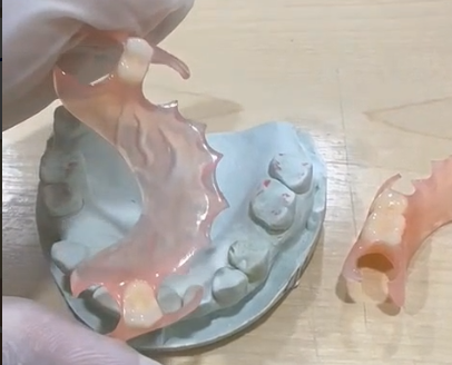 Flexible Denture-thumb