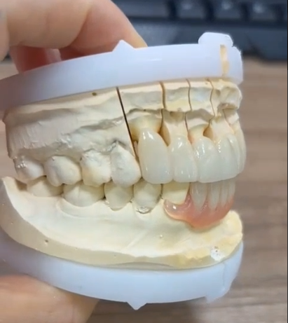 Flexible denture with zirconia Bridge-thumb