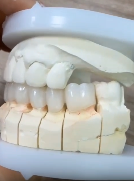 Full Contour Zirconia Bridge-thumb-1