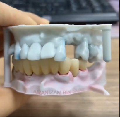 Full Contour Zirconia Bridge