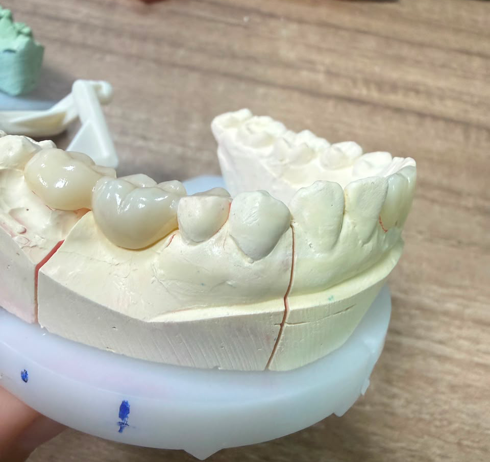 Full-Contour-Zirconia