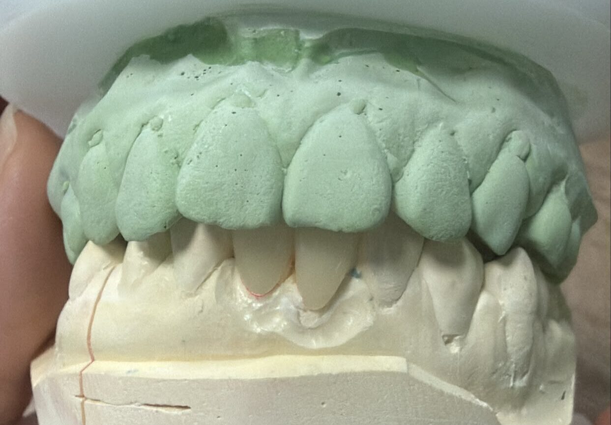 Dental technician polishing a zirconia crown restoration with precision tools