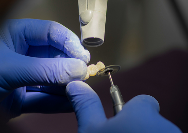 Full Contour Zirconia