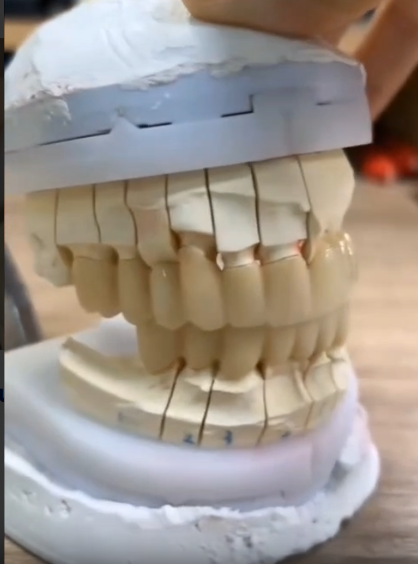 Full Contour Zirconia-thumb-3