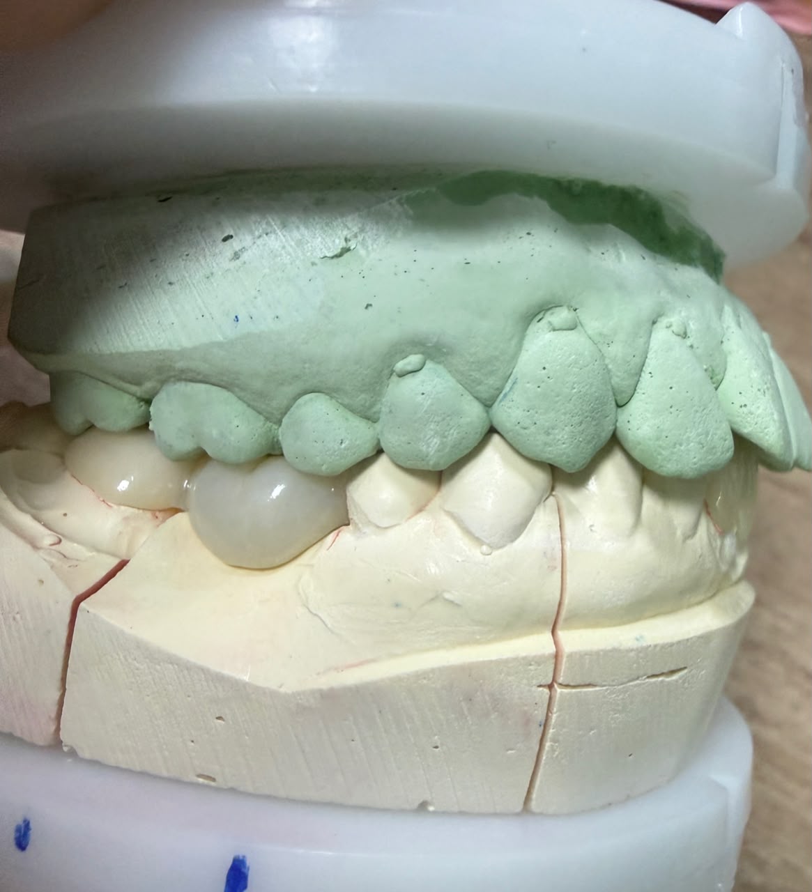 Full Contour Zirconia
