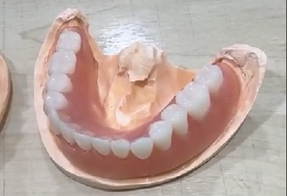 Full Mouth Valplast Denture
