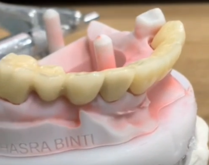 Full contour Zirconia and PFM. Mix bridge-thumb