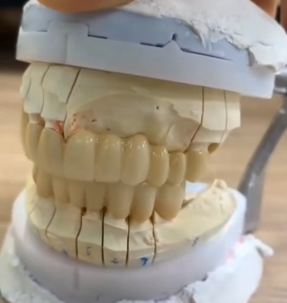 Full contour Zirconia-thumb-7