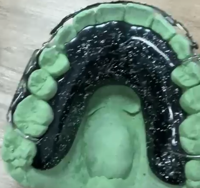 Hawley Retainer ( custom)