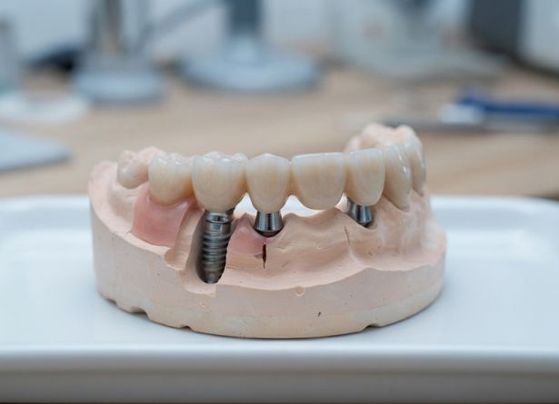Implants Crown & Bridge