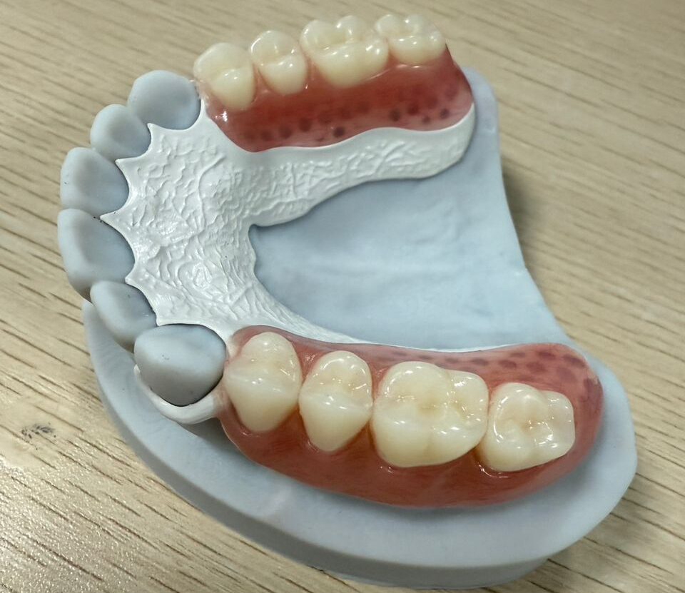 Peek-framework-denture
