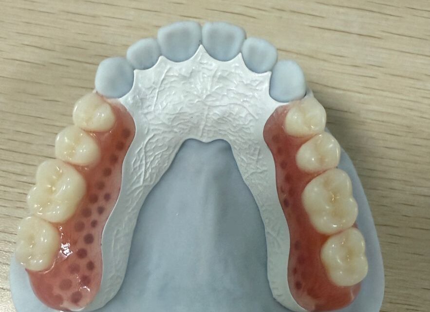 Peek-framework-denture