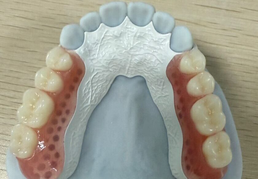 Peek framework denture