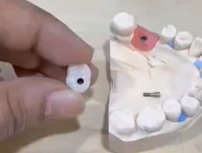 Zirconia Implant